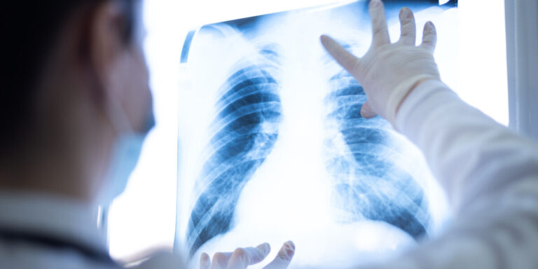 20 000 volontaires recherchés pour le dépistage du cancer du poumon en France