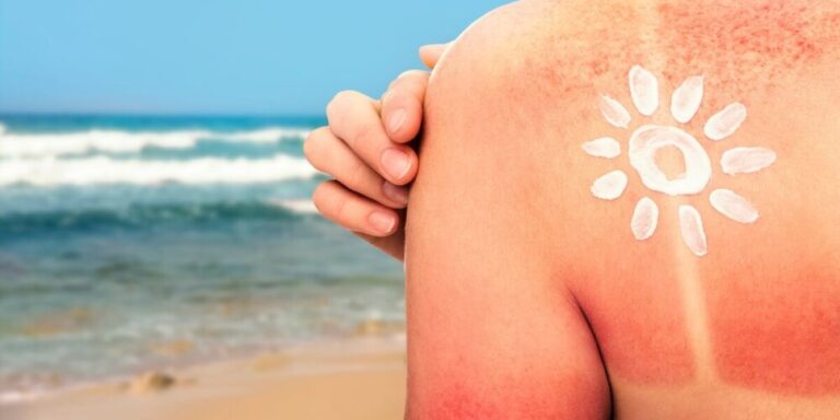 Des dermatologues français lancent une campagne de sensibilisation au soleil pour prévenir le cancer de la peau